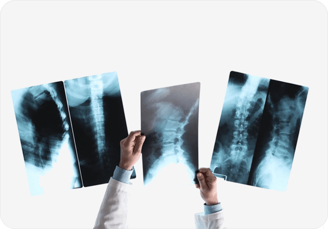 A person holding up two x-rays in front of them.